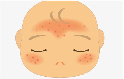 新生儿湿疹的六个症状