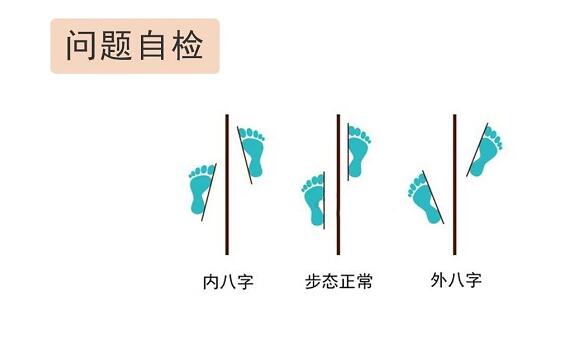 形成不良走路习惯,及时改正很重要,尽早配矫正鞋干预是关键
