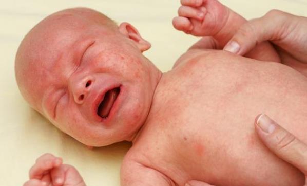 《婴儿湿疹护理宝典:科学应对,让宝宝告别红痒困扰》