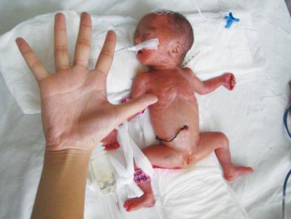 早产儿呵护指南:脆弱生命的温暖守护