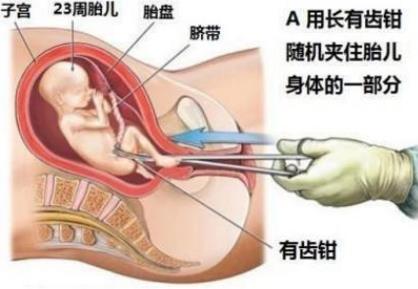 产妇流产:伤痛背后的知识与关怀