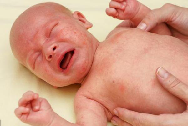 婴儿湿疹:宝宝肌肤的“烦恼”与应对之策